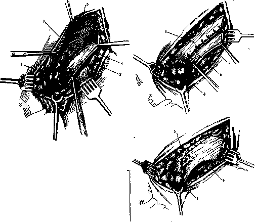 Hernias: figure 13 from the 1928–1936 encyclopedia article