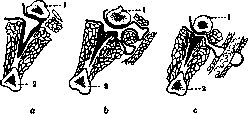 Hernias: figure 6 from the 1928–1936 encyclopedia article
