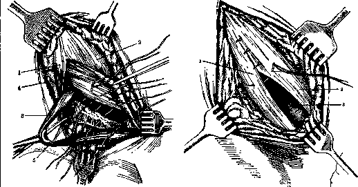 Hernias: figure 14 from the 1928–1936 encyclopedia article
