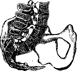 Spondylolisthesis: figure 2 from the 1928–1936 encyclopedia article