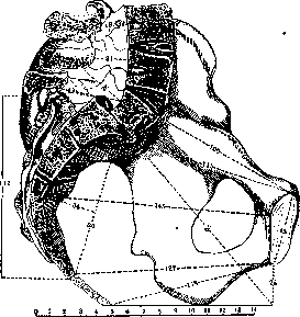 Spondylolisthesis: figure 1 from the 1928–1936 encyclopedia article