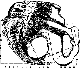 Spondylolisthesis: figure 3 from the 1928–1936 encyclopedia article