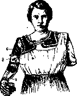 Prostheses: figure 7 from the 1928–1936 encyclopedia article