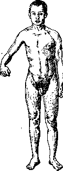 Hemiplegia: figure 2 from the 1928–1936 encyclopedia article