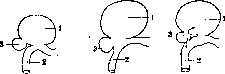 Peptic Ulcer: figure 1 from the 1928–1936 encyclopedia article