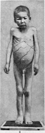 Leishmaniases: figure 3 from the 1928–1936 encyclopedia article