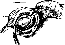 Hydrocele: figure 2 from the 1928–1936 encyclopedia article