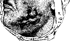 Actinomycosis: figure 1 from the 1928–1936 encyclopedia article