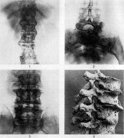 Spondylodeses: figure 1 from the 1928–1936 encyclopedia article