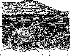 Aortic Aneurysm: figure 2 from the 1928–1936 encyclopedia article