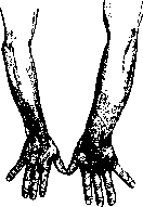 Hemiclonia: figure 1 from the 1928–1936 encyclopedia article