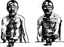 Dysmetria: figure 1 from the 1928–1936 encyclopedia article