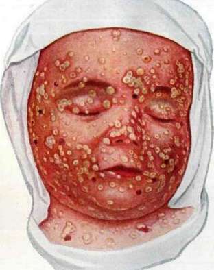 Chickenpox: figure 1 from the 1928–1936 encyclopedia article