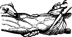 Infusion: figure 4 from the 1928–1936 encyclopedia article