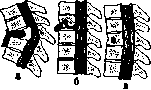 Spondylitis: figure 16 from the 1928–1936 encyclopedia article