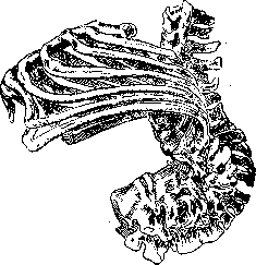 Spondylitis: figure 12 from the 1928–1936 encyclopedia article