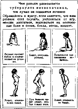 Spondylitis: figure 19 from the 1928–1936 encyclopedia article