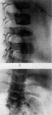 Spondylitis: figure 3 from the 1928–1936 encyclopedia article