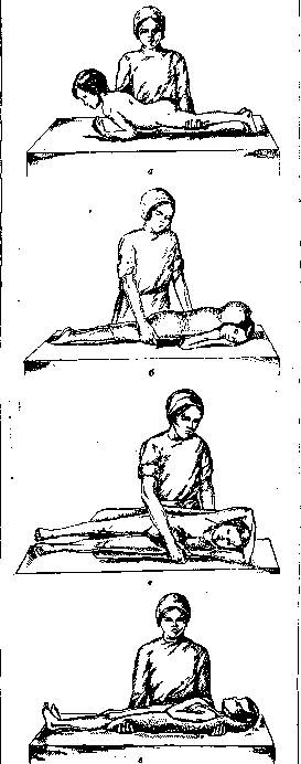 Spondylitis: figure 22 from the 1928–1936 encyclopedia article