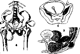 Spondylitis: figure 15 from the 1928–1936 encyclopedia article