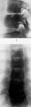 Spondylitis: figure 2 from the 1928–1936 encyclopedia article