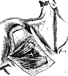 Mohrenheim's Fossa and Moria: figure 2 from the 1928–1936 encyclopedia article