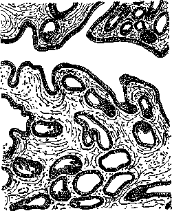 Adenoma: figure 1 from the 1928–1936 encyclopedia article